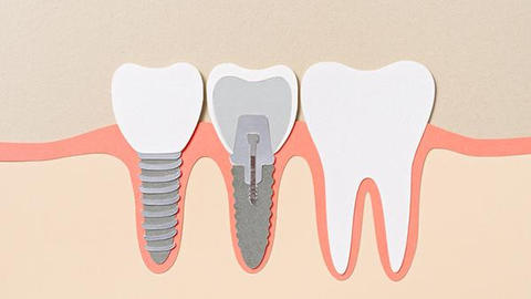 An illustration of a tooth implant