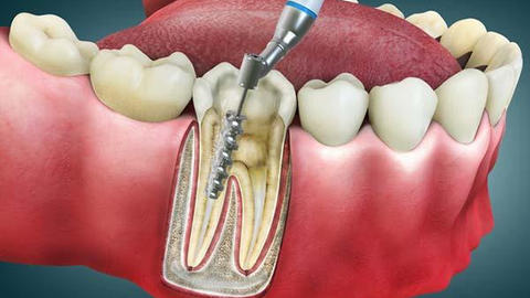 a model showing a drill probing a tooth