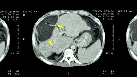 scan image of liver