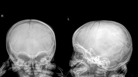 skull x-rays