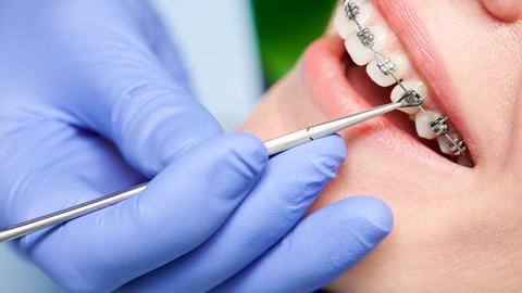 close up of a gloved hand with a dental instrument working on a patients braces