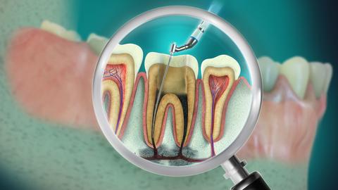 3D illustration of Endodontic root canal treatment. 