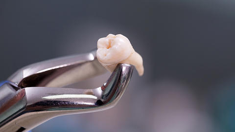 tooth pulled