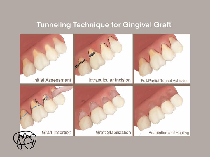 Illustration of the tunneling technique for gingival graft