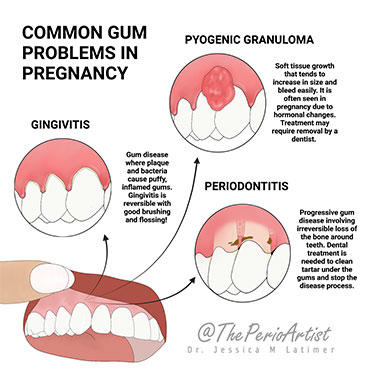 Four detailed drawings by Latimer depicting close-up views of teeth and gums show stages of gum disease,