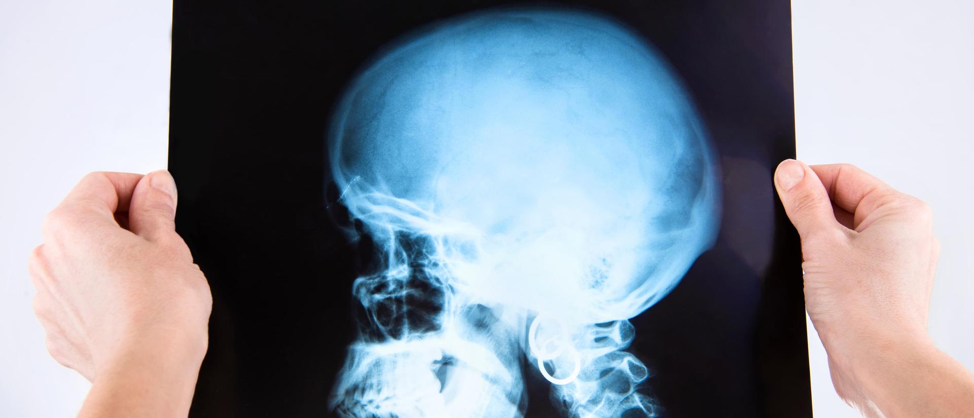 skull x-ray