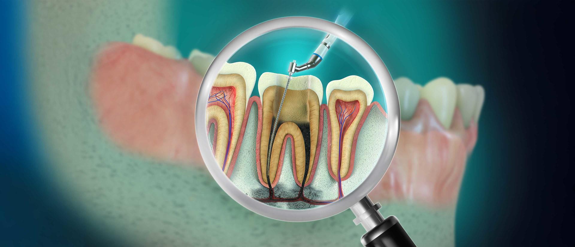 diagram of the cross section of a tooth undergoing a root canal