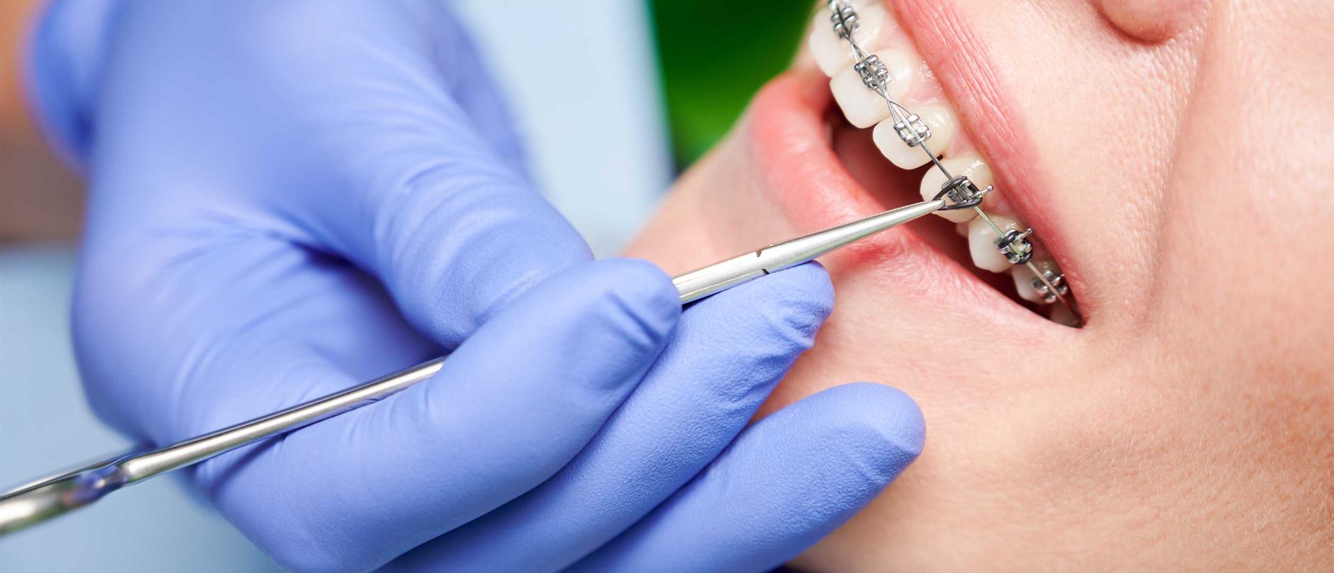 close up of a gloved hand with a dental instrument working on a patients braces